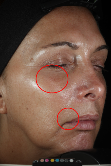 effacer les rides avec le rétinol