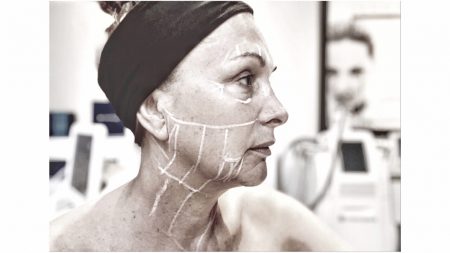 lift sans chirurgie Ulthéra